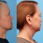 Korekcja i chirurgia plastyczna odstających uszu - z czego się składa?